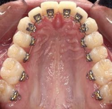 Arteriovenous Fistula Doctors